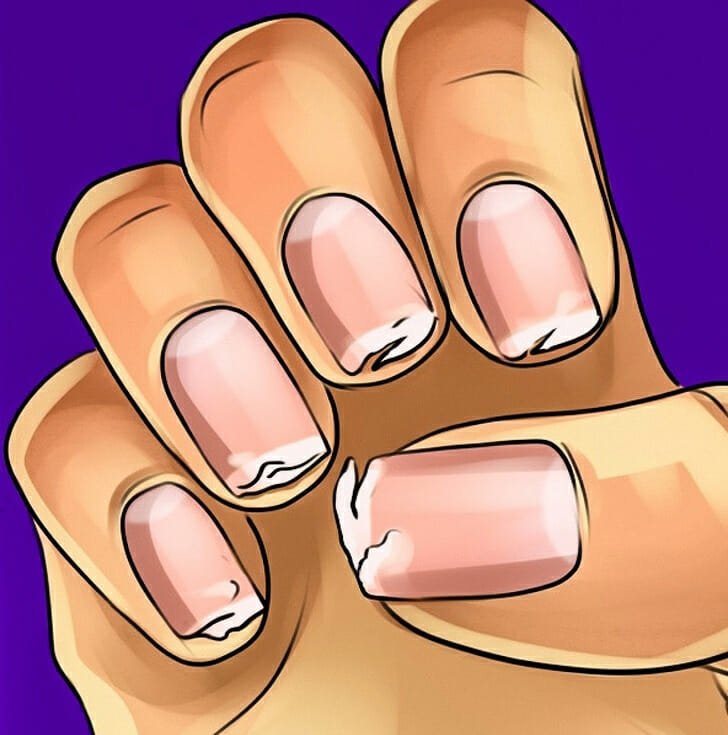 شکنندگی ناخن و کمبود کلسیم