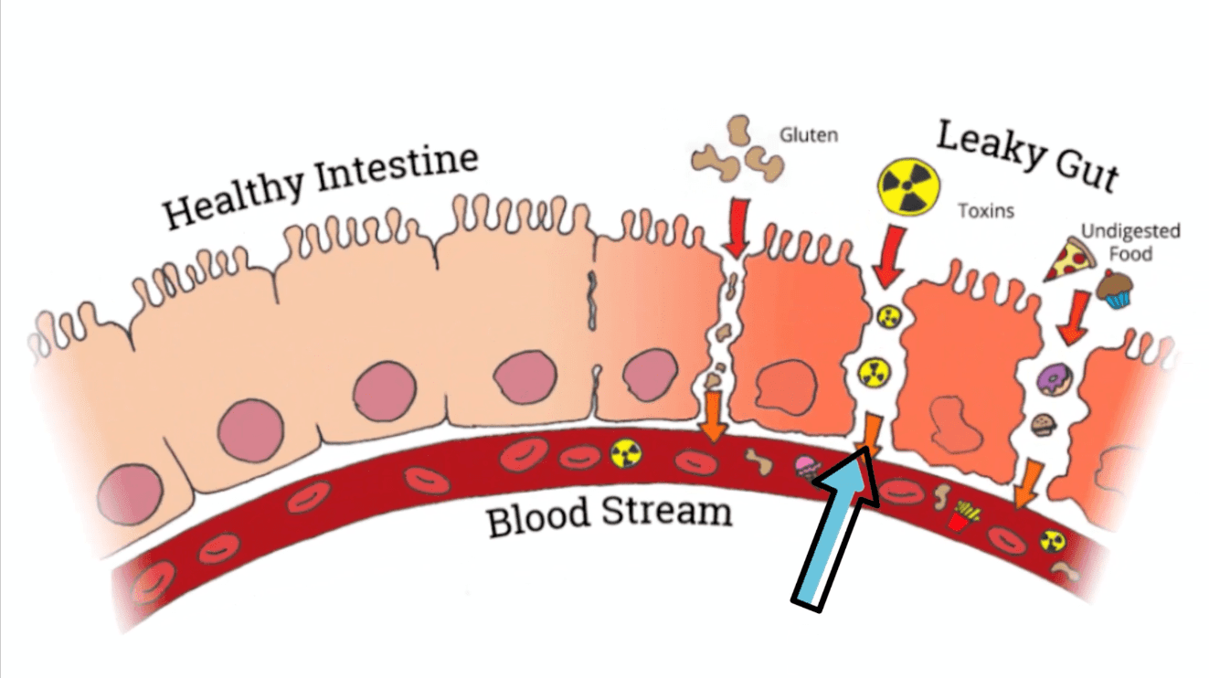سندروم روده تحریک پذیر گلوتن و IBS