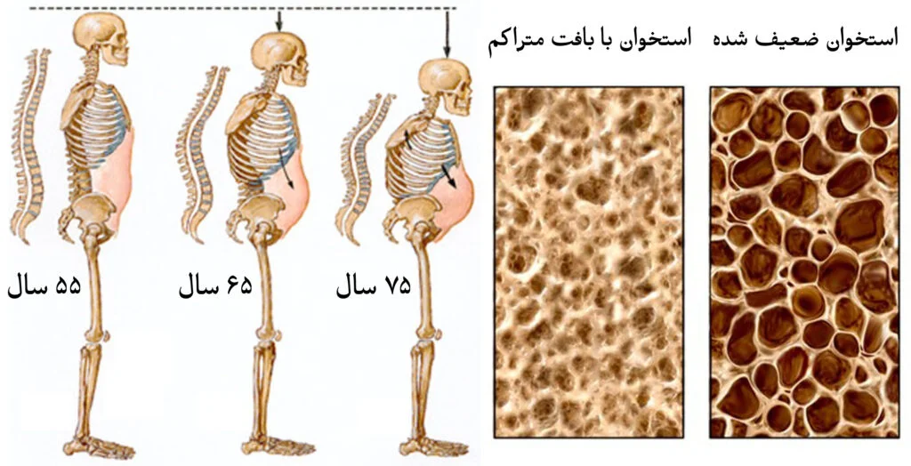 پوکی استخوان چیست؟-2
